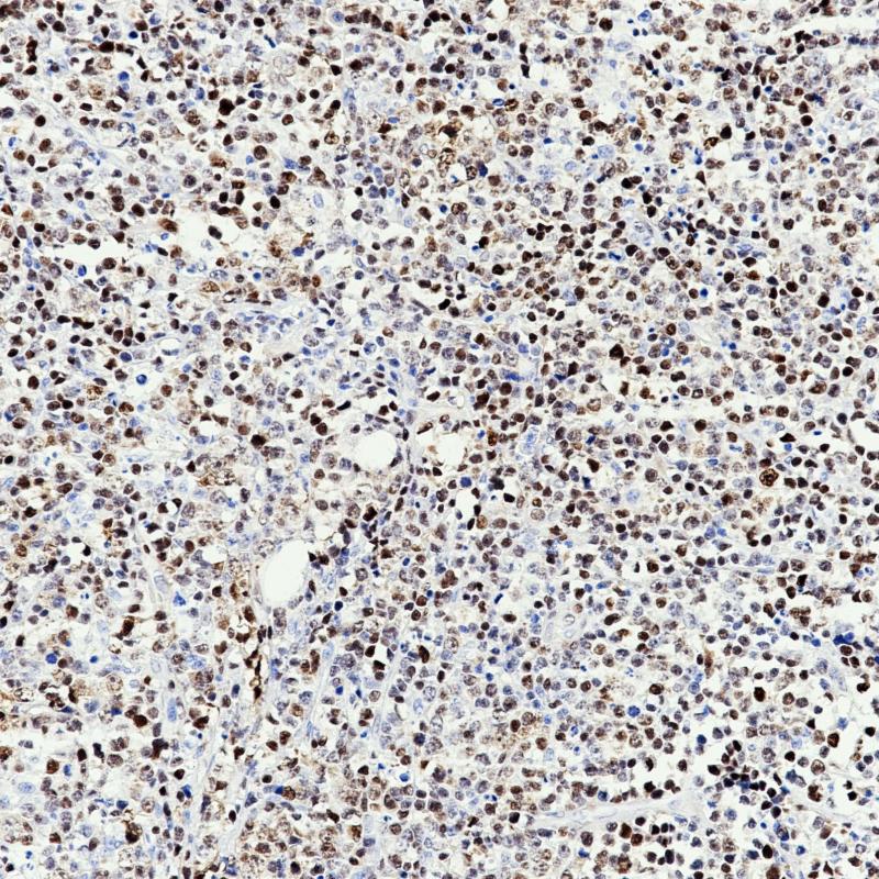 Mantle cell lymphoma